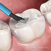 pediatric-dental-sealants-300.jpg