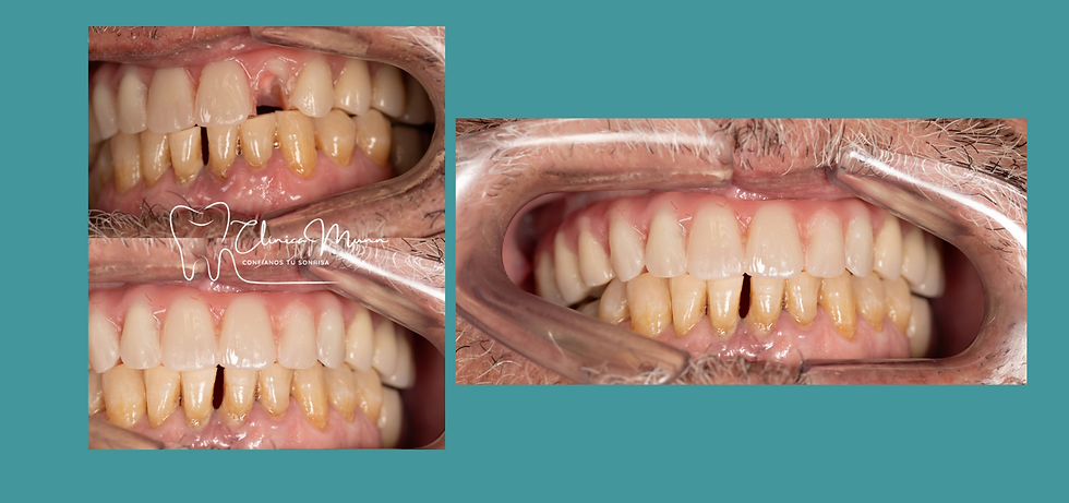 🦷 Reparación rápida de prótesis fija sin quitarla: caso real en Clínica Dental Munn