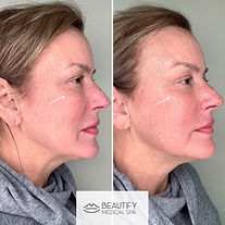 Beautify Botox Glow Treatment | BEAUTIFY Medical Spa