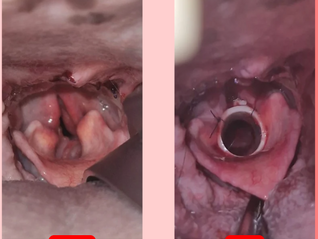 Colocación de Stent laríngeo en perros con parálisis laríngea: guía para veterinarios