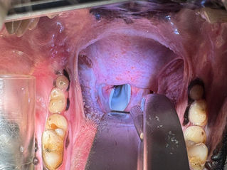 From a tracheostomy to restoring airflow with a silicone laryngeal stent 