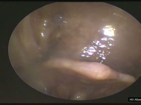 Success story: Treatment of laryngeal paralysis in an elderly patient using a silicone stent