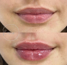 Lip filler before and after comparison
