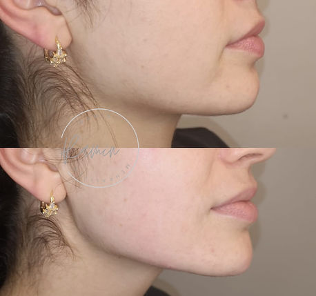 Dermal filler treatment result showing facial profile enhancement