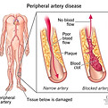 17357-peripheral-artery-disease.jpeg