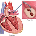 mitraclip-diagram.jpeg