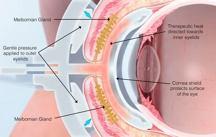 LipiFlow treatment