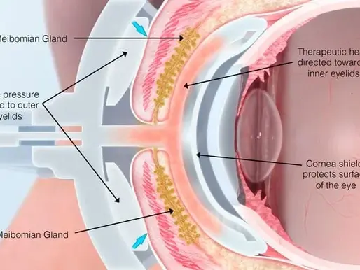 What is LipiFlow Treatment for Dry Eye Syndrome, and Does It Work?