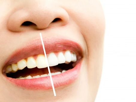 Achieve a Stunning Smile with Dubai Teeth Whitening