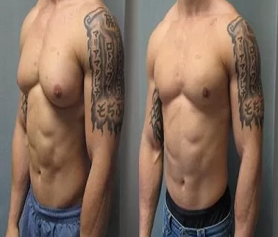 The Benefits of Gynecomastia Surgery for Men