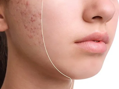 Achieve Clear Skin: Innovative Acne Treatments in Dubai