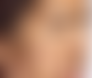 Why Melasma Treatment Has Everyone Talking Online
