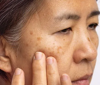 Why Melasma Treatment Has Everyone Talking Online
