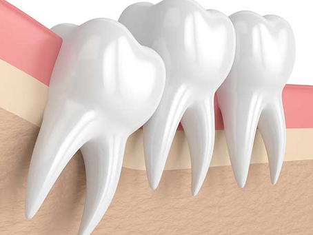 What to Expect with Tooth Extraction Cost