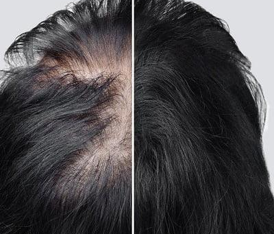 Exosomes For Hair Loss New Era Of Hair Restoration Science