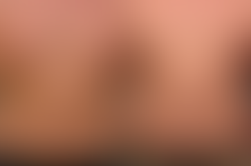 The Benefits of Gynecomastia Surgery