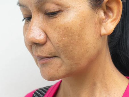 How Long Does It Take to See Results From Melasma Treatment Therapy?