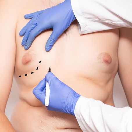Reveal a New Confident You With Gynecomastia Surgery