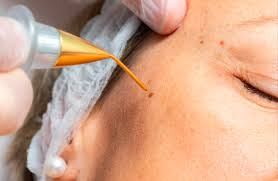 Top Dermatologist-Approved Warts Treatments in Dubai
