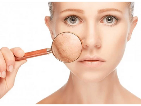 Reveal Your Skin’s True Beauty Using Melasma Treatment
