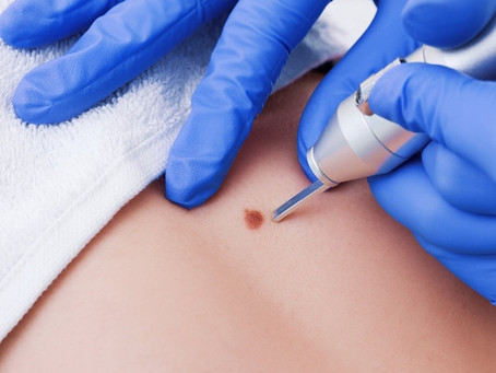 Top Methods for Removing Warts in Dubai