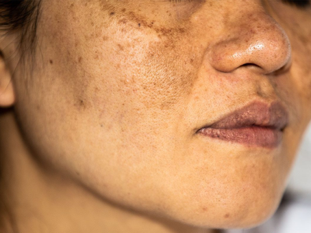 Melasma Treatment That Delivers Next Level Skin Radiance