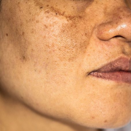 Melasma Treatment That Delivers Next Level Skin Radiance