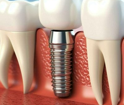 Get Closer to Your Best Smile Using Focused Single Tooth Implant Cost Tips