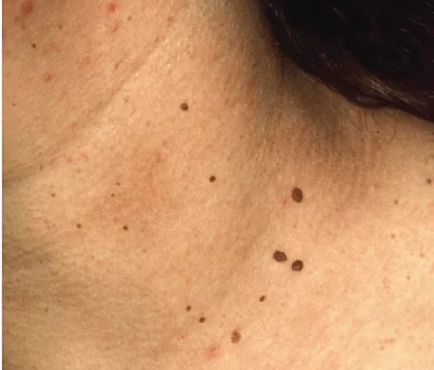 Warts Be Gone: Discover Your Treatment Options