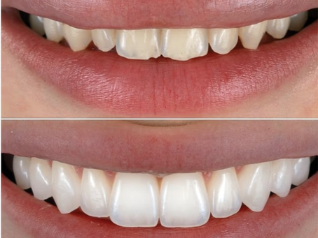 Unlock dazzling smile transformation with Non-Prep Veneers now