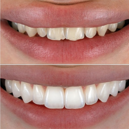 Unlock dazzling smile transformation with Non-Prep Veneers now