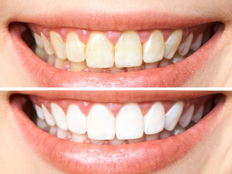 Enhance Your Smile with Veneers Dubai Guide