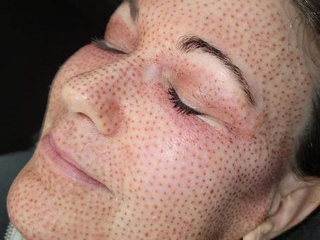 Defy Aging Gracefully With Revolutionary Plasma Pen Treatment