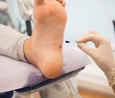Warts Begone: Discover Dubai’s Best Removal Options