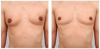 Exploring Gynecomastia Surgery in Dubai: A Guide
