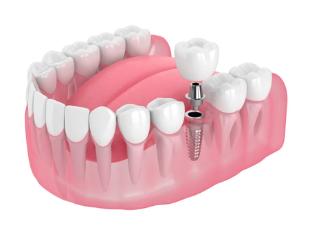 Step into Perfect Smile Shine Using Single Tooth Implant Cost