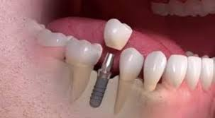 The Benefits of Opting for a Single Tooth Implant in Dubai