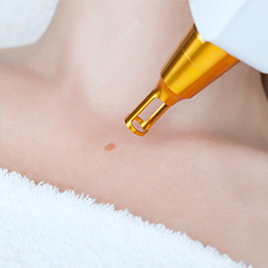 Safe Solutions for Warts in Dubai: Effective Treatments for Smooth, Healthy Skin