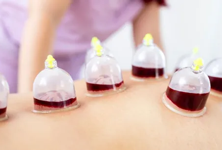 Recharge Energy and Wellness Naturally Through Hijama Cupping Therapy