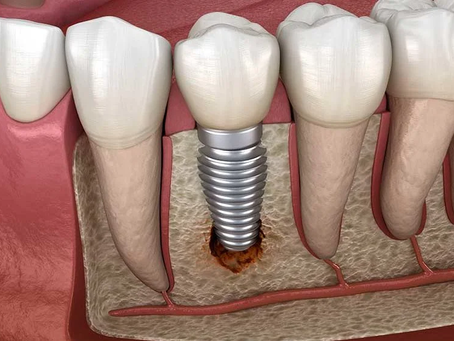 Single Tooth Implant Cost Powers Beautiful Smiles That Last Always