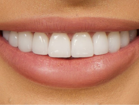 A Comprehensive Guide to Dental Veneers