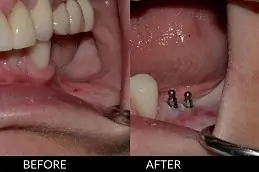 A Guide to Single Tooth Implants in Dubai