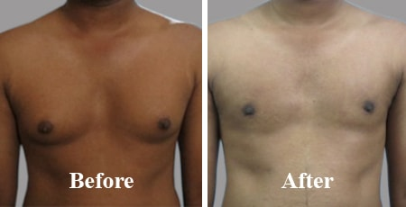 What to Expect from Gynecomastia Surgery in Dubai