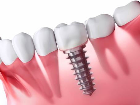 Discovering Single Tooth Implants: What You Need to Know