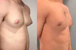 Is Gynecomastia Surgery Right for You?