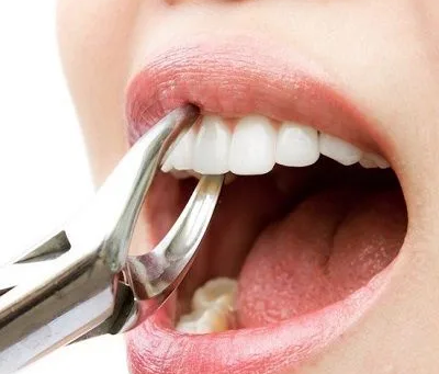 Average Tooth Extraction Price in Dubai Revealed