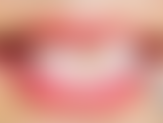 Veneers: A Quick Smile Makeover in Dubai