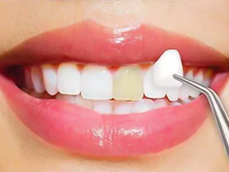 Veneers: A Quick Smile Makeover in Dubai