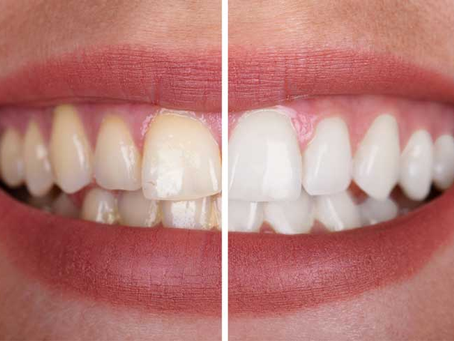 Everything You Should Know About Whitening Cost