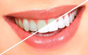 Achieve a Dazzling Smile with Teeth Whitening